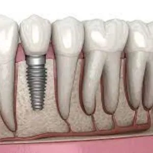 Crown Dental Implants