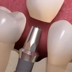 Dhaman Dental Implants