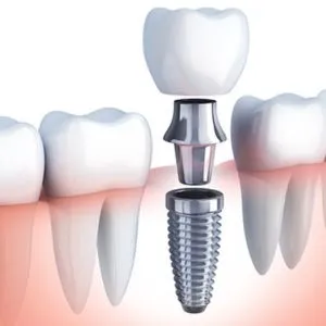 Bright Dental Implants