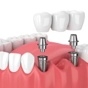 Afdal Dental Implants