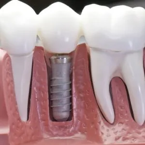 California Dental Implants