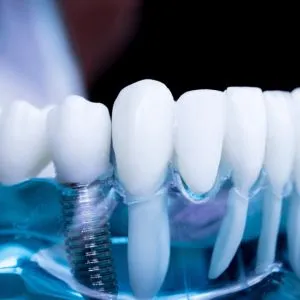 Pearl Dental Implant