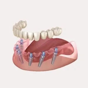 All On Six Dental Implants