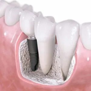 Same Day Dental Implants