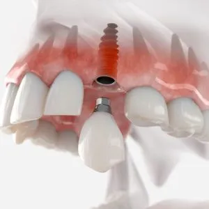 3D Guided Dental Implants