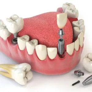 Nova Dental Implants