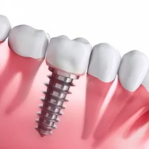 Thumbay Dental Implant