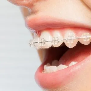 Invisalign Treatment